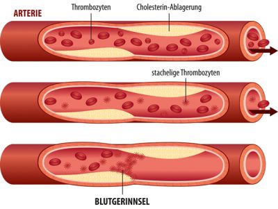 Gesunde Durchblutung vs. Arterienverstopfung